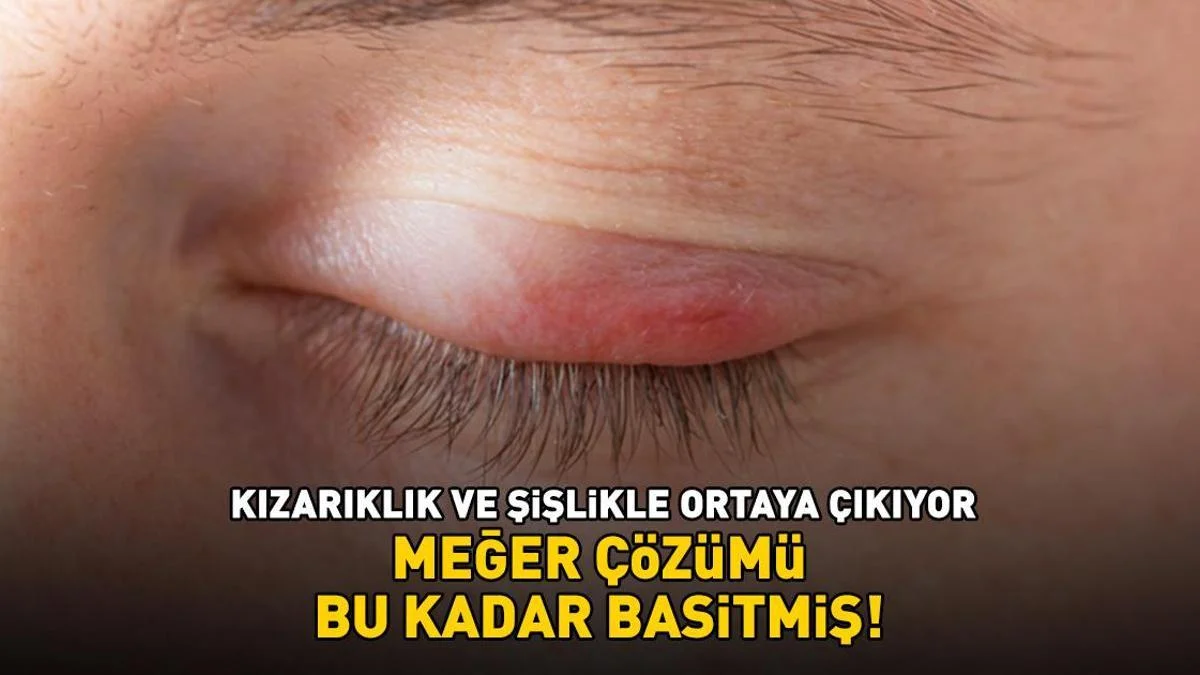 G&ouml;z kapağı iltihabına ne iyi gelir? Kızarıklık ve şişlikle ortaya &ccedil;ıkıyor!